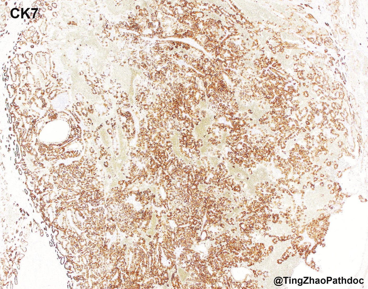 Papillary renal cell carcinoma — CK7: diffuse, strong