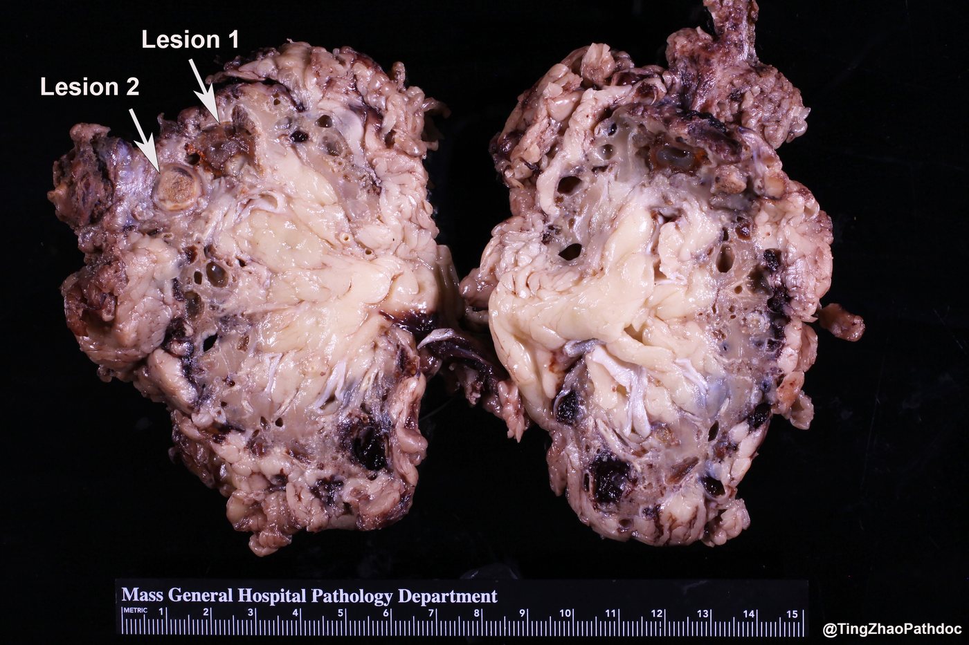 Papillary renal cell carcinoma — Gross: end-stage kidney with acquired cysts — lesion 1 papillary RCC, lesion 2 ACD-RCC