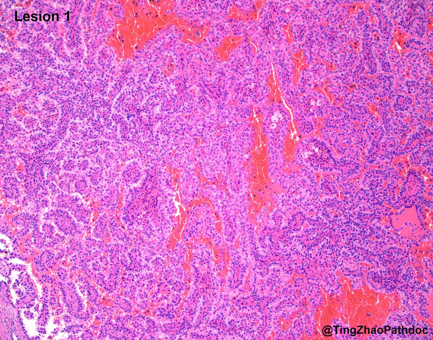Papillary renal cell carcinoma — Lesion 1: tubulopapillary growth with foamy macrophages and haemorrhage
