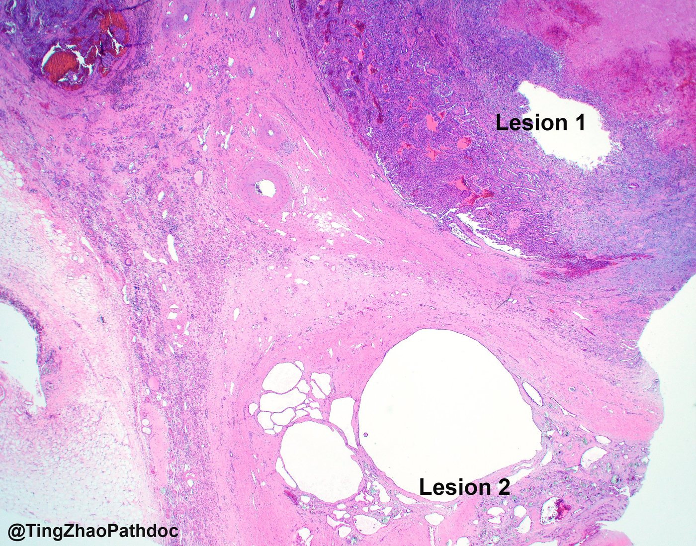 Papillary renal cell carcinoma — Low power: lesion 1 (papillary RCC) and lesion 2 (ACD-RCC)
