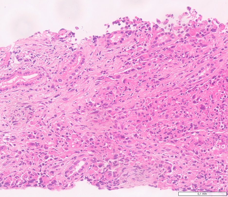 SMARCB1-deficient renal medullary carcinoma: Infiltrative cords, small glands and single cells in inflamed desmoplastic stroma
