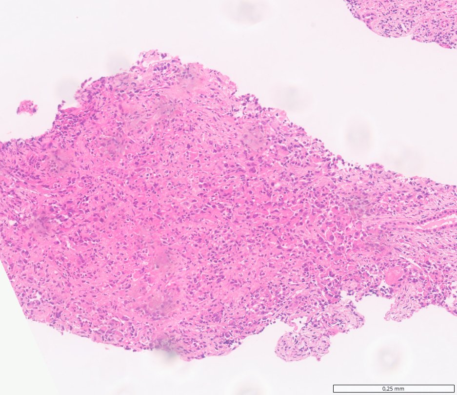 SMARCB1-deficient renal medullary carcinoma: Core biopsy: solid sheets of discohesive tumour cells with inflammation