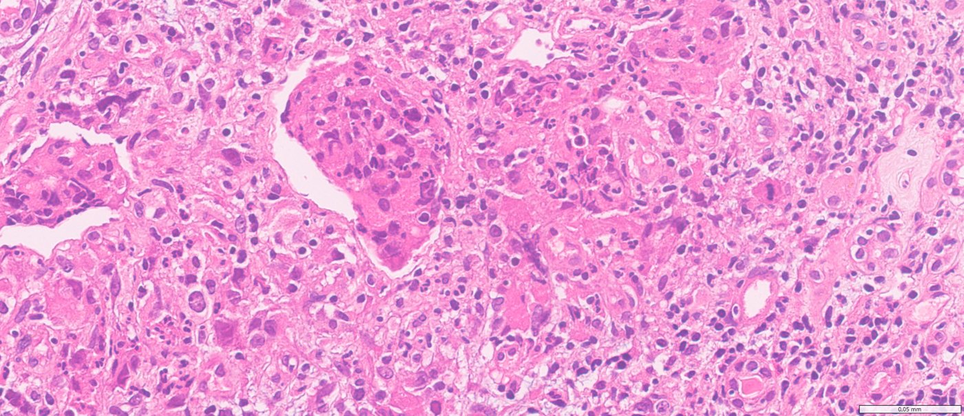 SMARCB1-deficient renal medullary carcinoma: High power: pleomorphic and rhabdoid cells amid neutrophils and lymphocytes
