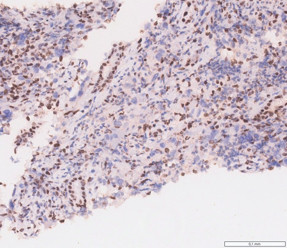 SMARCB1-deficient renal medullary carcinoma: INI1 (SMARCB1): loss in tumour cells, retained in inflammatory and stromal cells