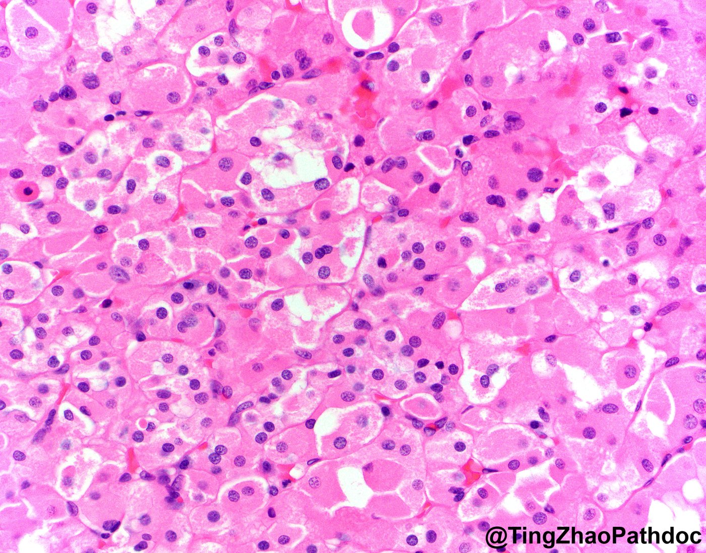 Succinate dehydrogenase-deficient renal cell carcinoma: High power: vacuoles with pale flocculent eosinophilic inclusions