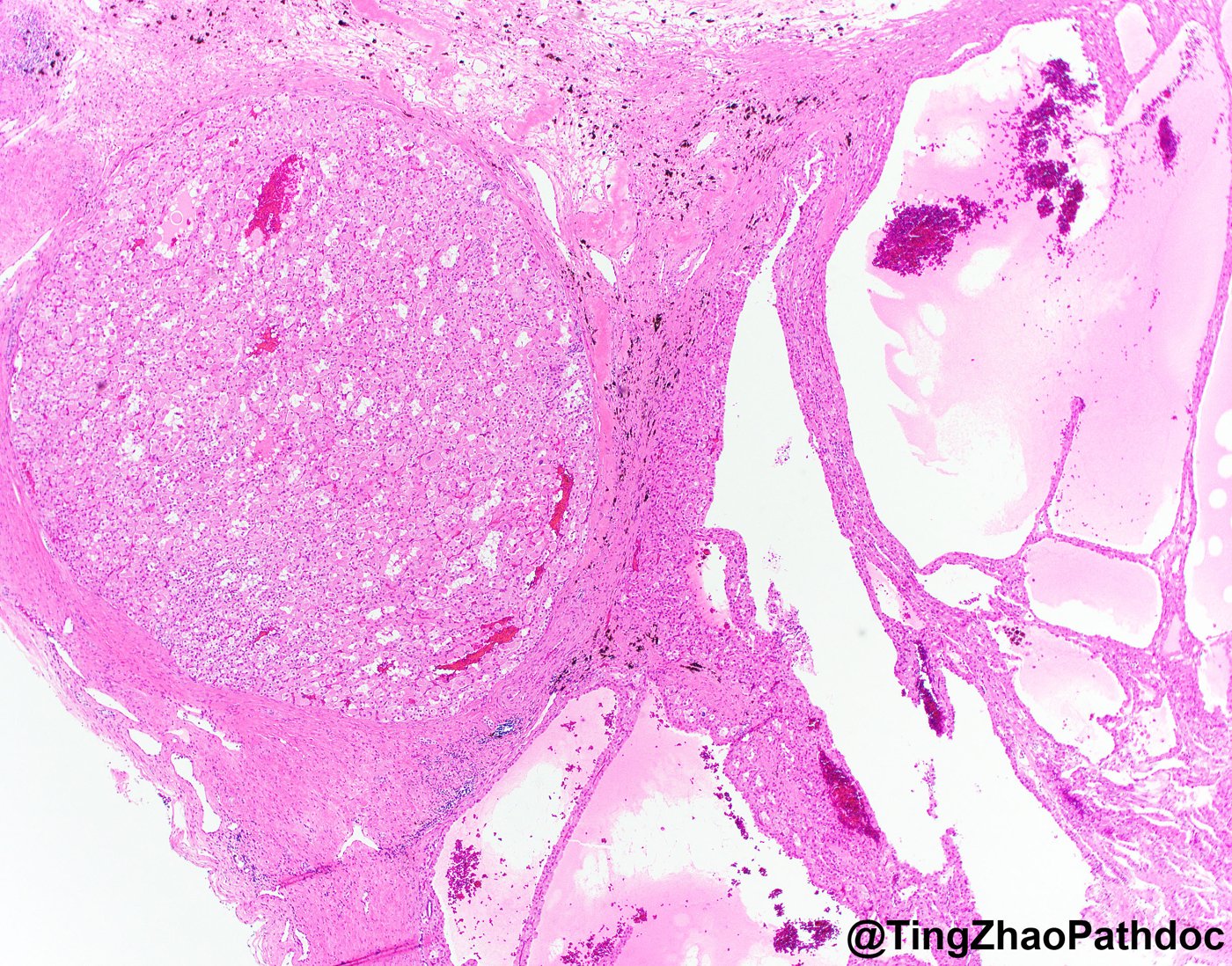 Succinate dehydrogenase-deficient renal cell carcinoma: Low power: solid nodule of eosinophilic cells beside a multicystic component