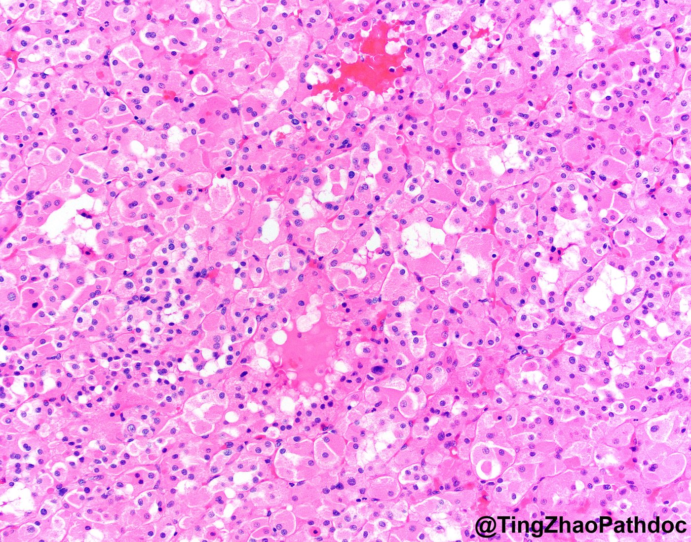 Succinate dehydrogenase-deficient renal cell carcinoma: Sheets of uniform eosinophilic cells with bubbly, vacuolated cytoplasm