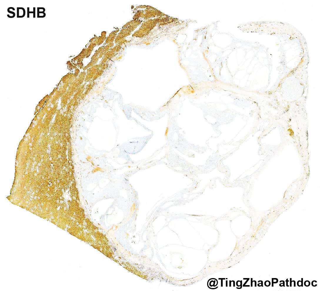 Succinate dehydrogenase-deficient renal cell carcinoma: SDHB: loss in the tumour, retained in adjacent kidney (whole mount)