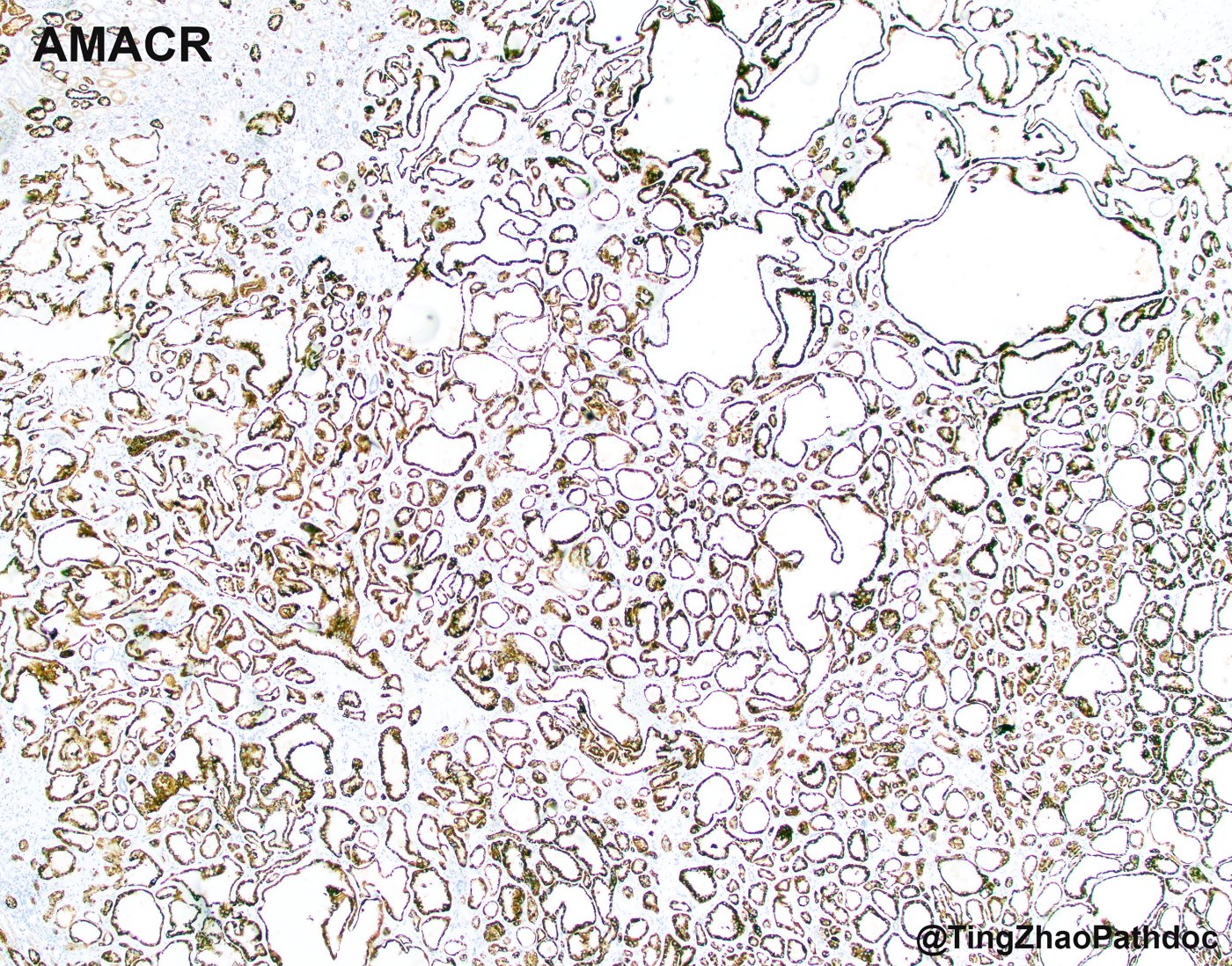 Tubulocystic renal cell carcinoma: AMACR (P504S): strong granular positivity in the lining cells
