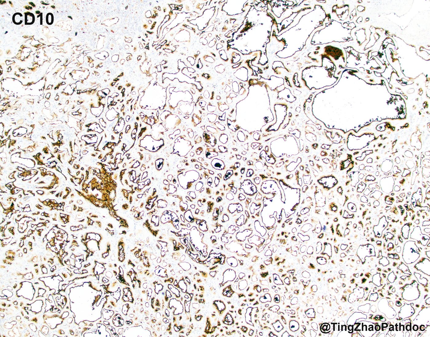 Tubulocystic renal cell carcinoma: CD10: luminal and membranous staining in many tubules and cysts