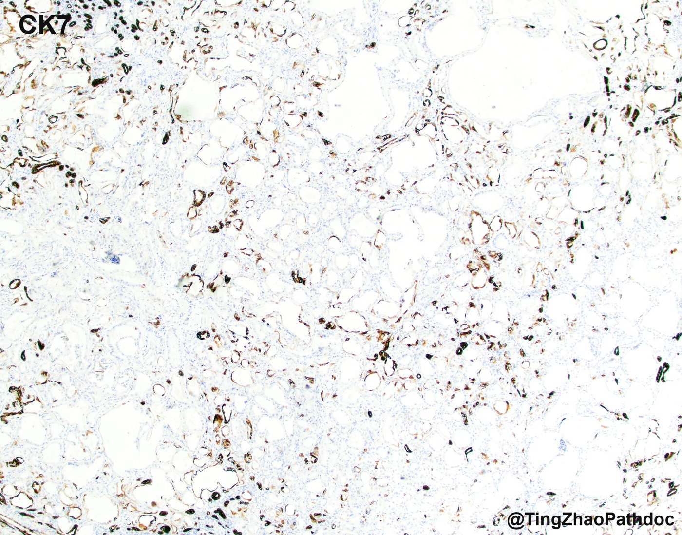 Tubulocystic renal cell carcinoma: CK7: only focal, patchy staining
