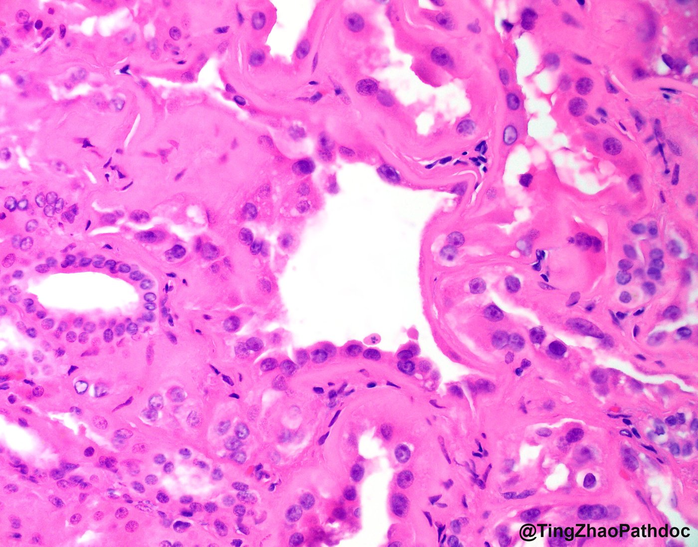 Tubulocystic renal cell carcinoma: High power: hobnail cells with prominent nucleoli and abundant pink cytoplasm