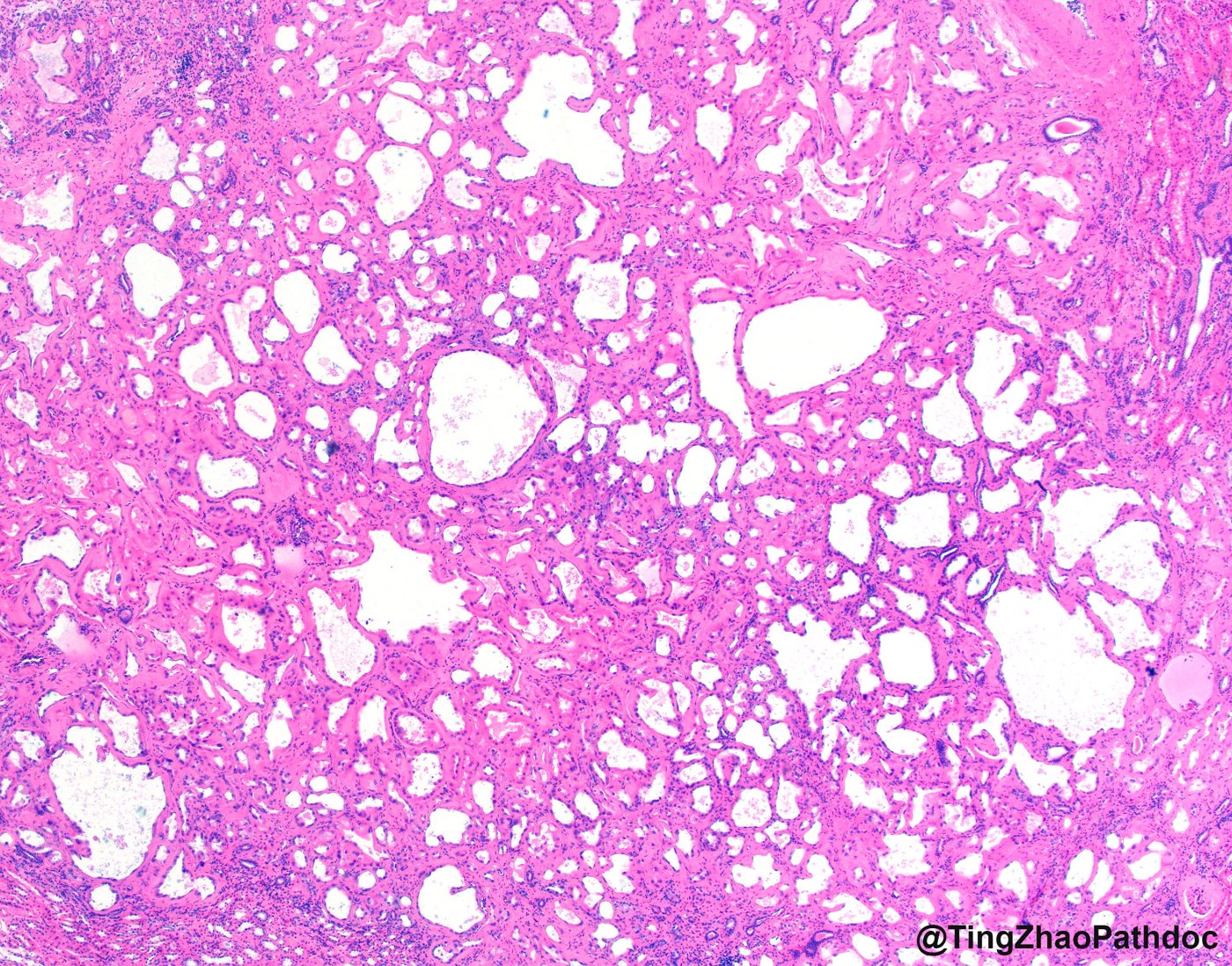 Tubulocystic renal cell carcinoma: Bubble-wrap pattern: packed tubules and cysts of varying size in thin fibrous septa