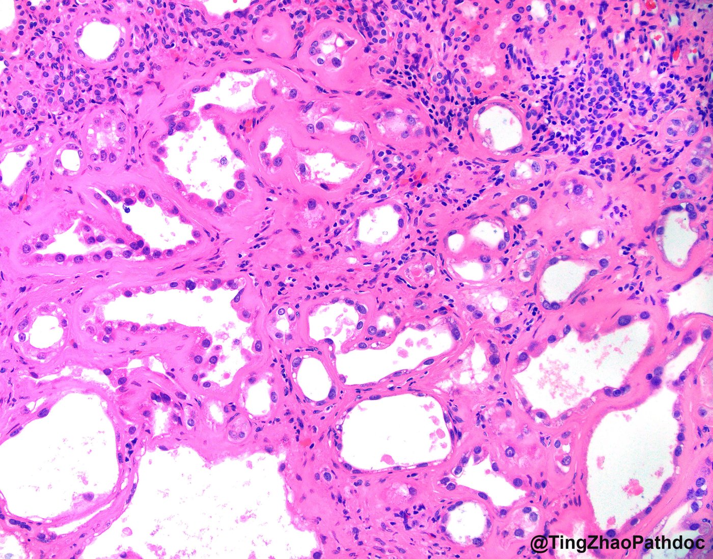 Tubulocystic renal cell carcinoma: Tubules and cysts lined by eosinophilic cuboidal and hobnail cells