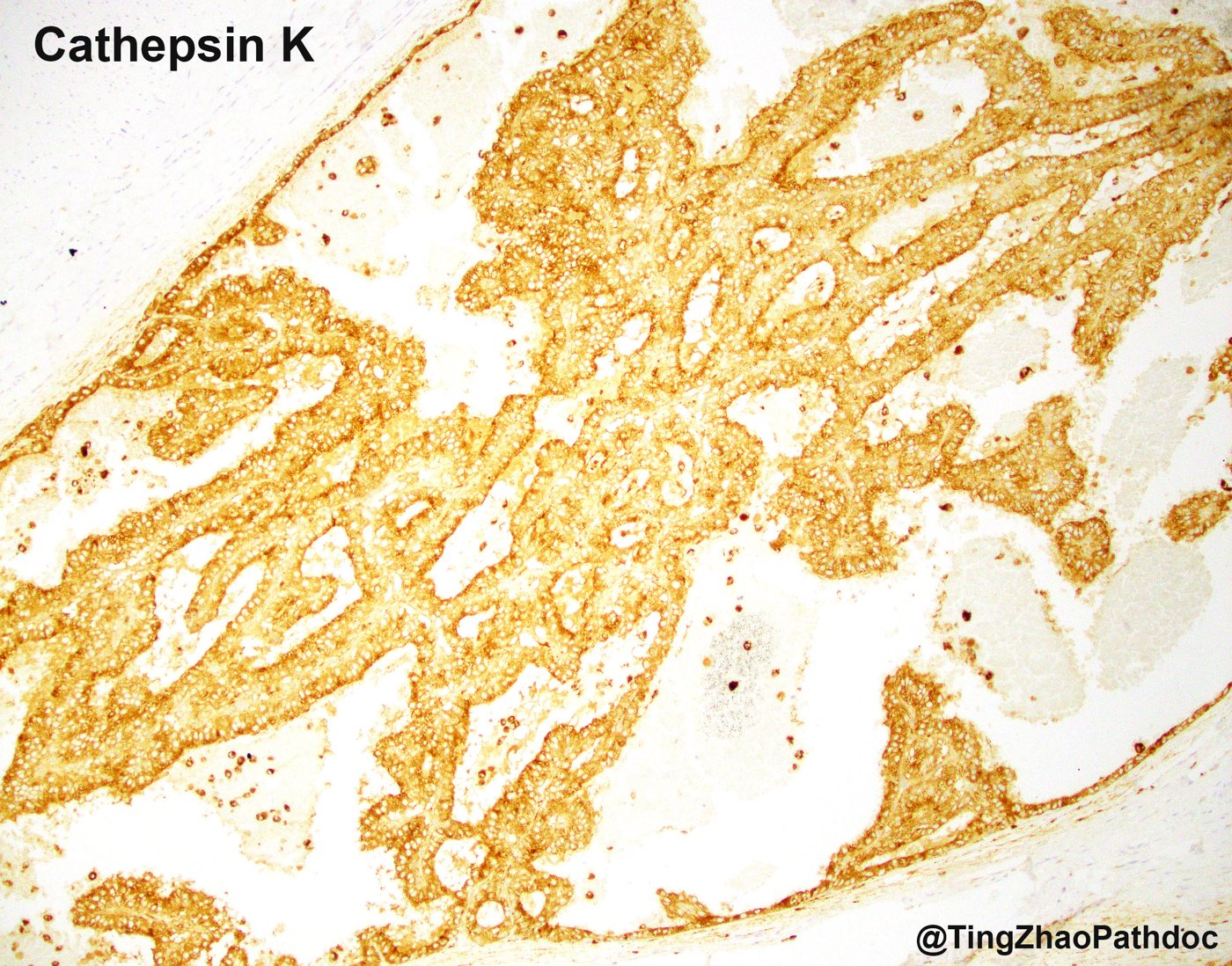 TFE3-rearranged renal cell carcinomas: Cathepsin K: diffuse cytoplasmic positivity