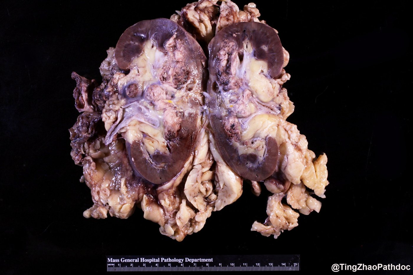 TFE3-rearranged renal cell carcinomas: Gross: tumour centred on the renal sinus with haemorrhage and necrosis