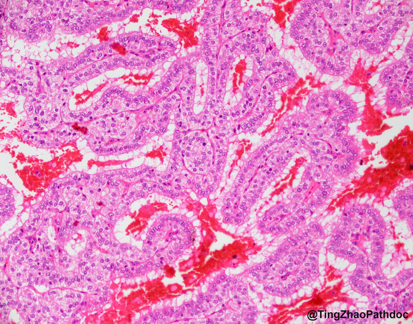 TFE3-rearranged renal cell carcinomas: Nests and tubules of large clear cells with distinct borders and haemorrhage