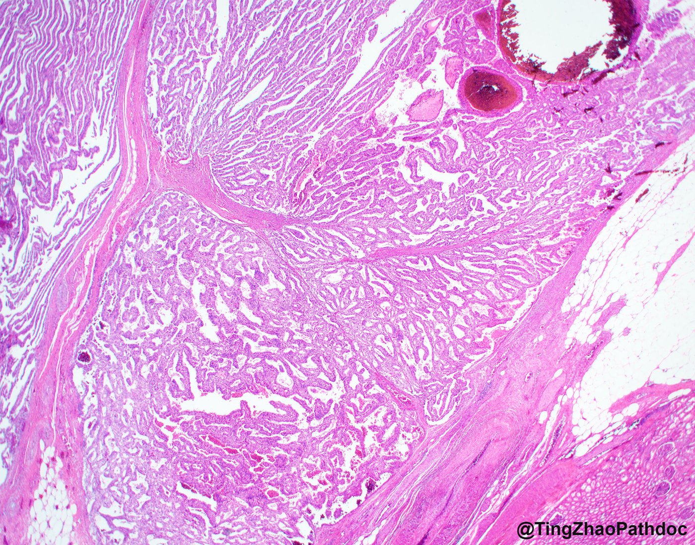 TFE3-rearranged renal cell carcinomas: Low power: papillary and nested growth divided by fibrous septa, with calcifications