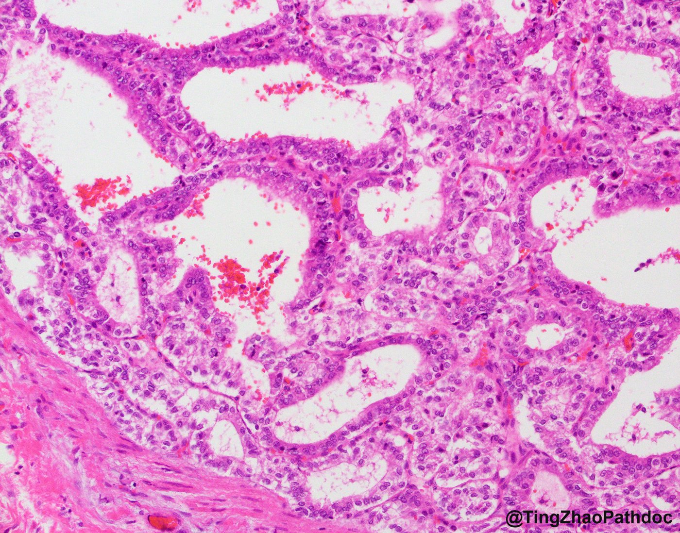 TFE3-rearranged renal cell carcinomas: Tubulopapillary growth of cells with clear to eosinophilic cytoplasm