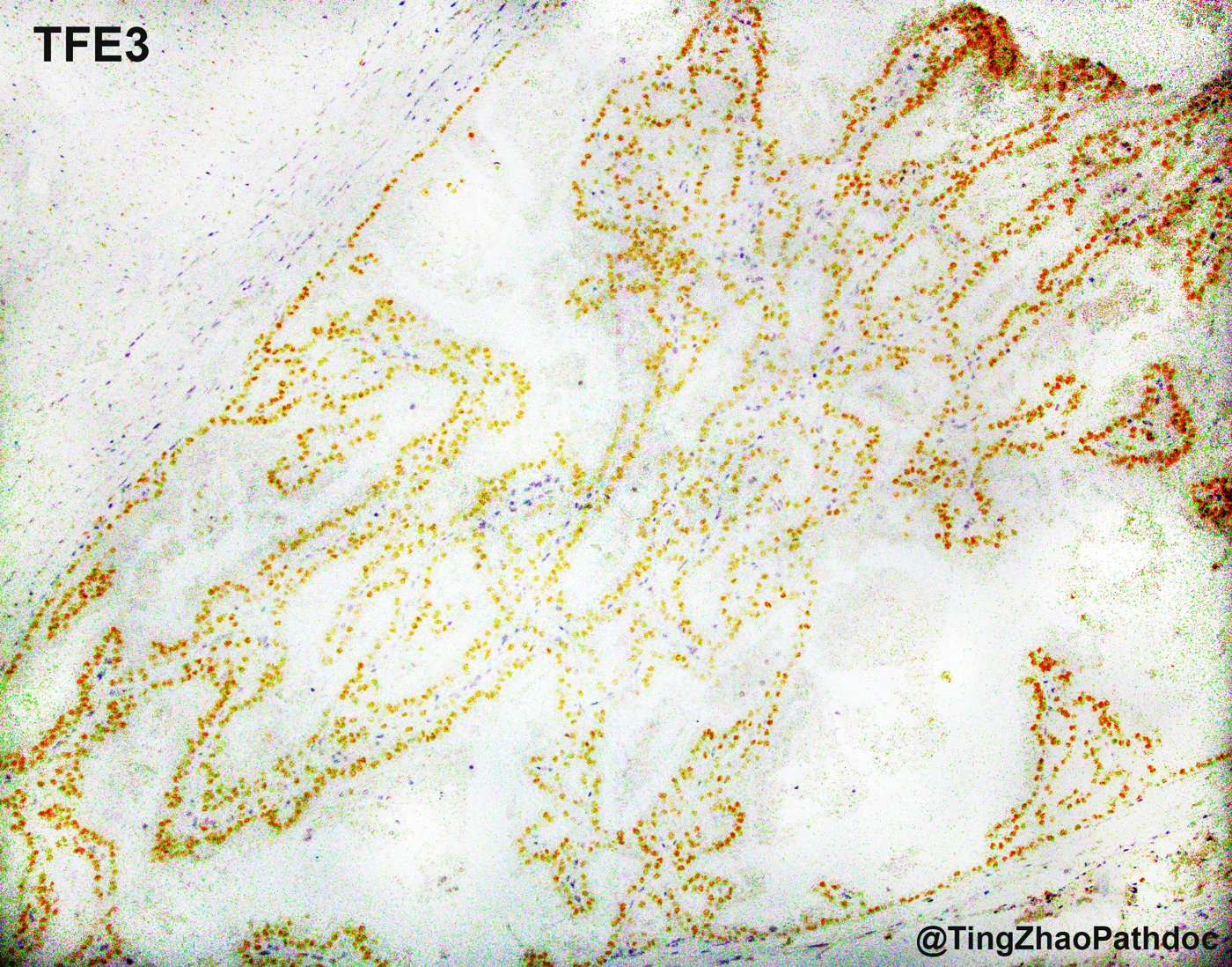 TFE3-rearranged renal cell carcinomas: TFE3: strong diffuse nuclear staining of tumour cells