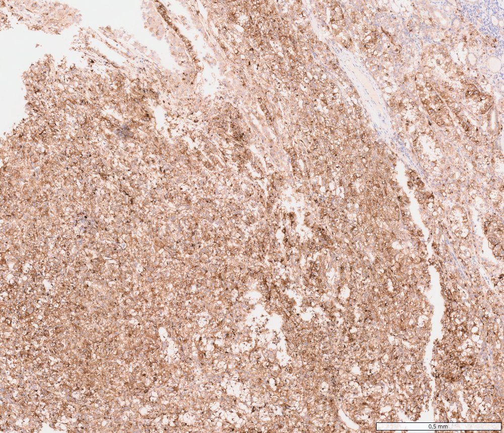 TFEB-altered renal cell carcinomas: Cathepsin K: diffuse cytoplasmic positivity