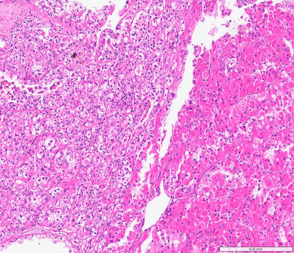 TFEB-altered renal cell carcinomas: Clear cell nests (left) and dense eosinophilic cells (right)