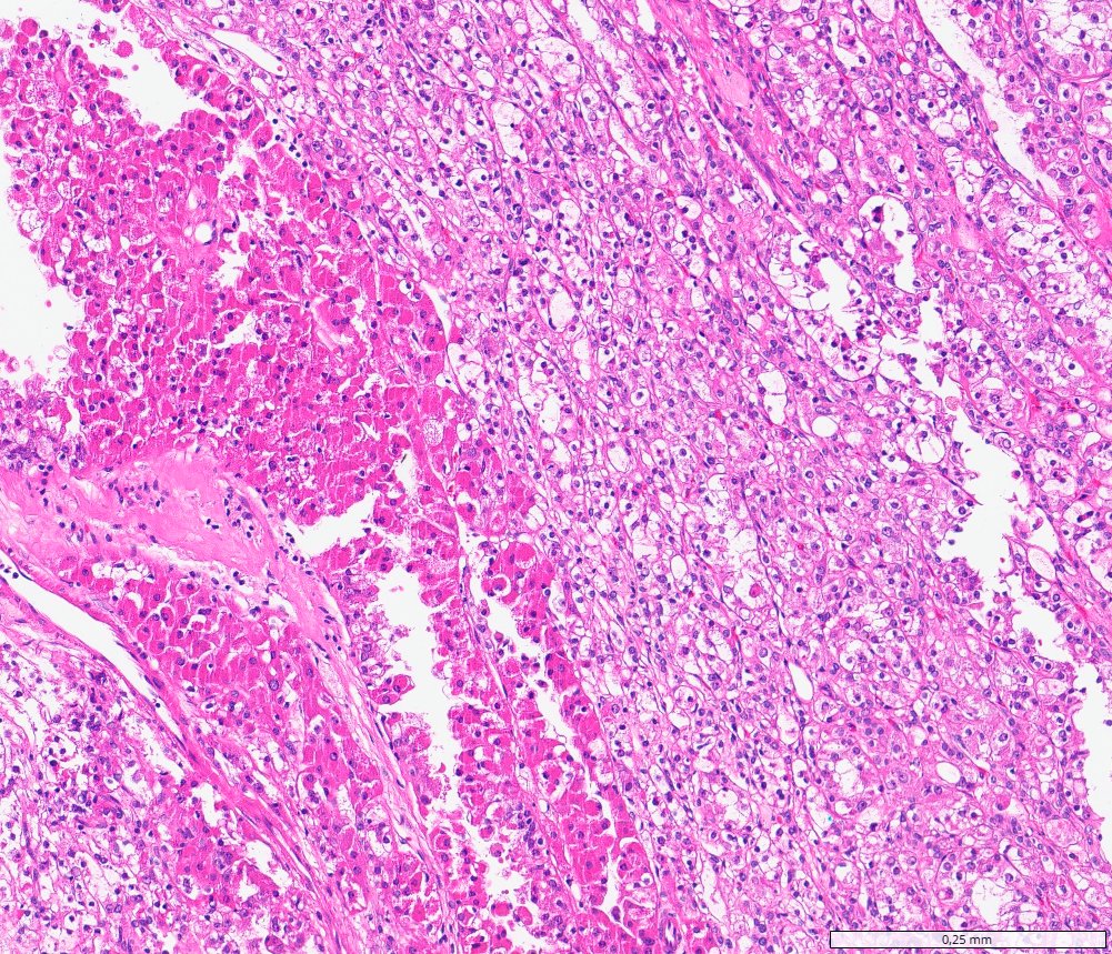 TFEB-altered renal cell carcinomas: TFEB-amplified RCC: clear cell areas beside densely eosinophilic cells