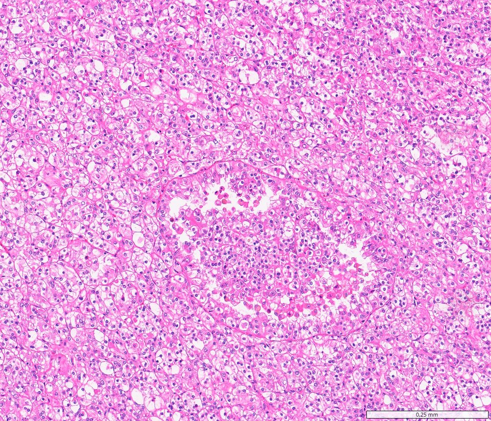TFEB-altered renal cell carcinomas: Clear to eosinophilic cells in nests with a central focus of loosely cohesive cells