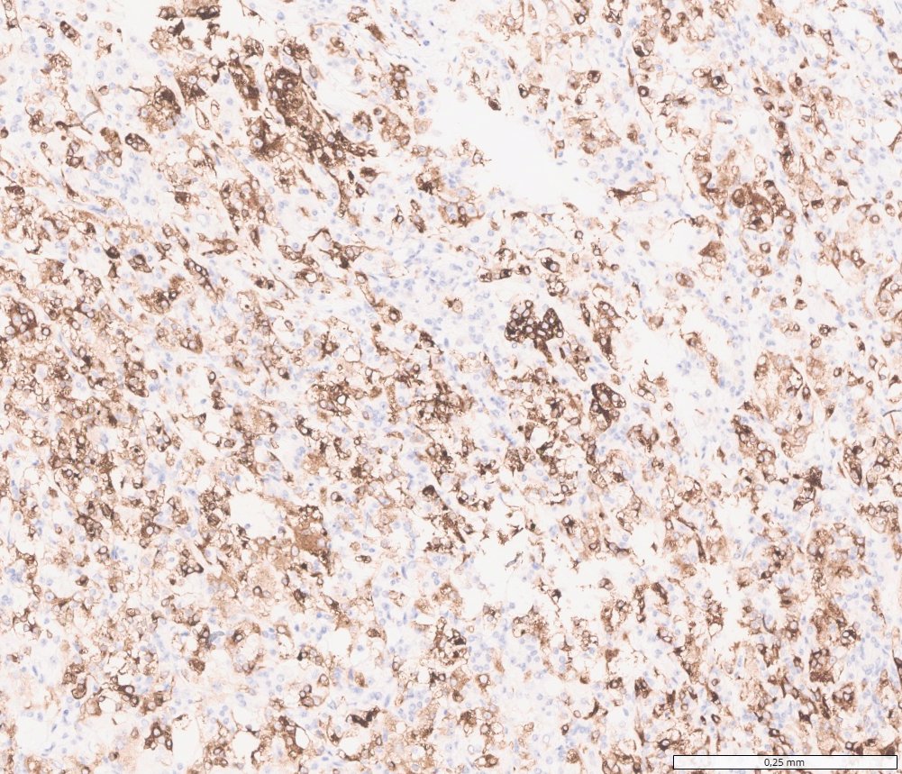 TFEB-altered renal cell carcinomas: Melan-A: patchy cytoplasmic positivity