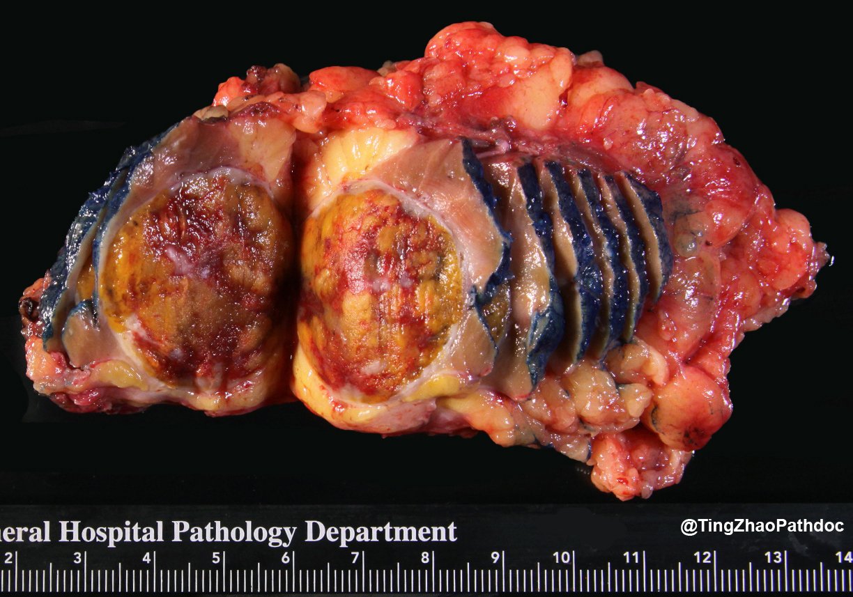 Thyroid-like follicular renal cell carcinoma: Gross: circumscribed yellow-tan haemorrhagic renal mass