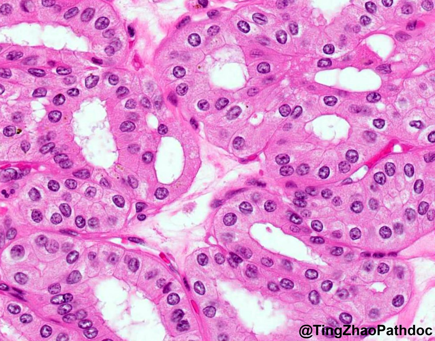 Thyroid-like follicular renal cell carcinoma: H&E high power: bland cuboidal cells around small lumina