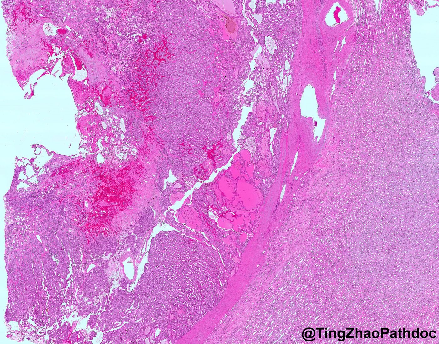 Thyroid-like follicular renal cell carcinoma: H&E low power: follicles with dense colloid-like material beside normal kidney