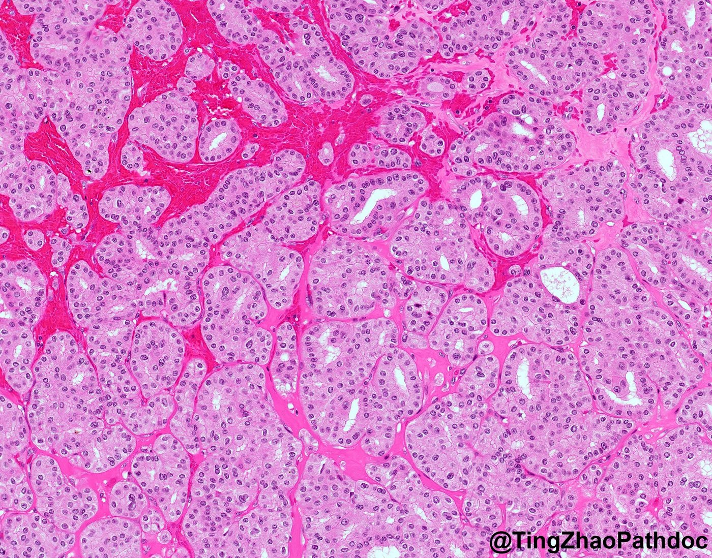 Thyroid-like follicular renal cell carcinoma: H&E medium power: closely packed small follicles in hyalinised stroma