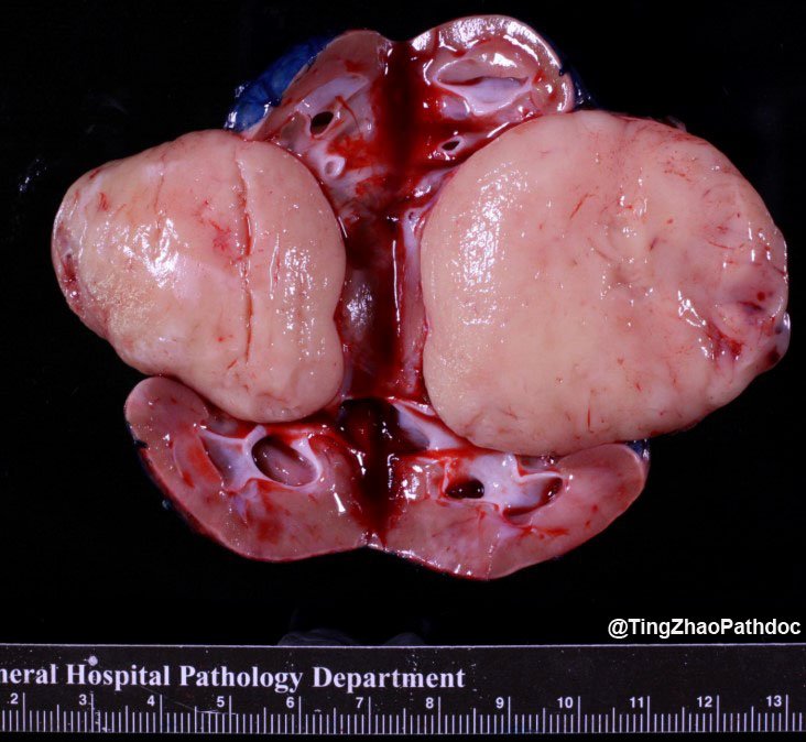 Nephroblastoma: Gross: large fleshy tan-white renal tumour