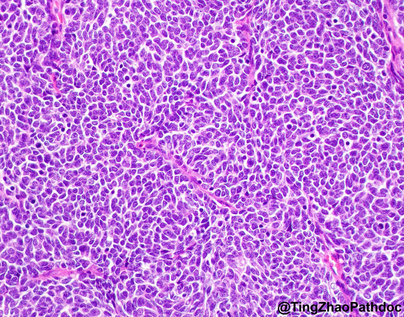 Nephroblastoma: H&E high power: blastemal cells
