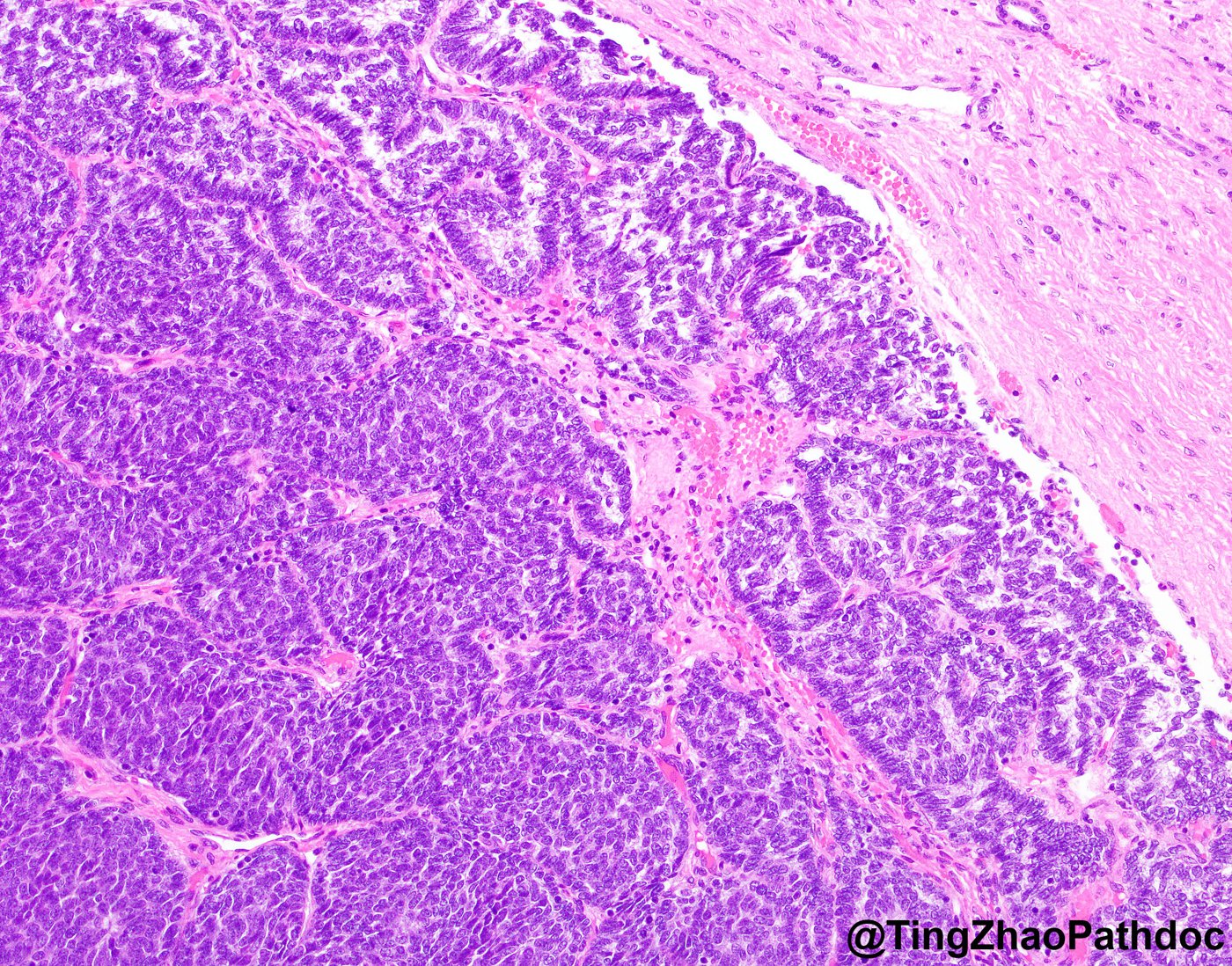 Nephroblastoma: H&E: blastema with early epithelial differentiation at the pseudocapsule