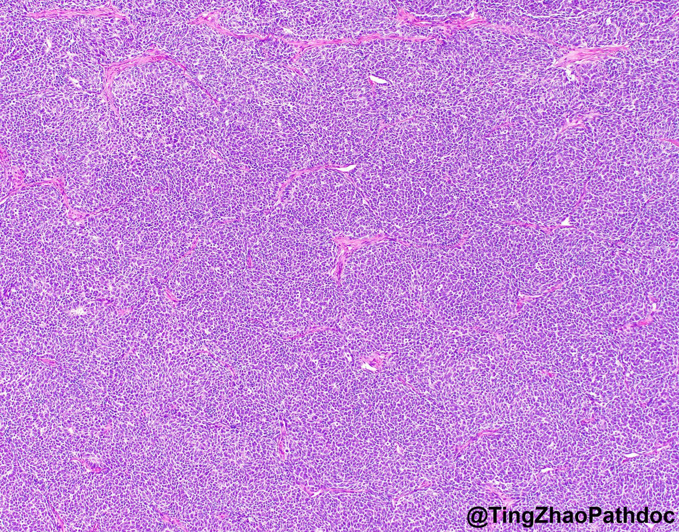 Nephroblastoma: H&E low power: blastemal-predominant sheets and nests
