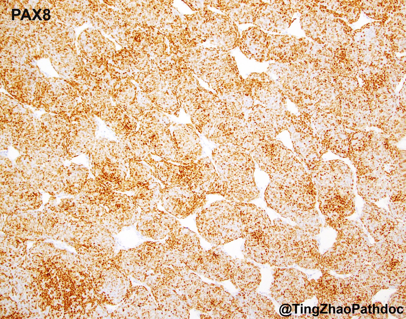 Nephroblastoma: PAX8: nuclear positivity in blastema and primitive epithelium