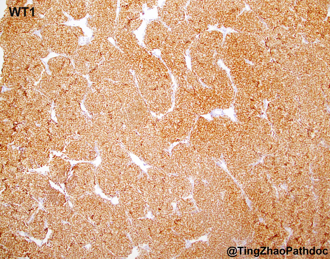 Nephroblastoma: WT1: diffuse nuclear positivity in blastema